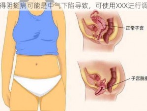 女得阴挺病可能是中气下陷导致，可使用XXX进行调理