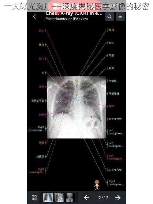 十大曝光胸片——深度揭秘医学影像的秘密